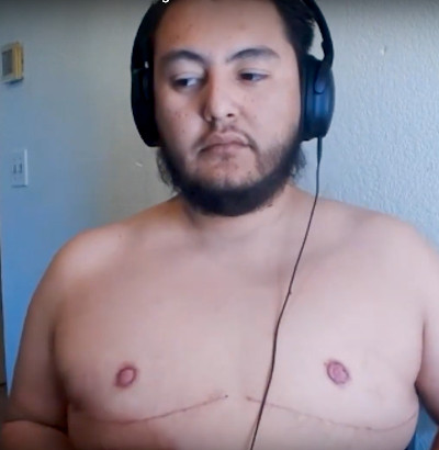 breasts implanted and then removed